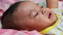 تقرير رسمي: 819 إصابة بالحصبة في تعز منذ مطلع العام الجاري